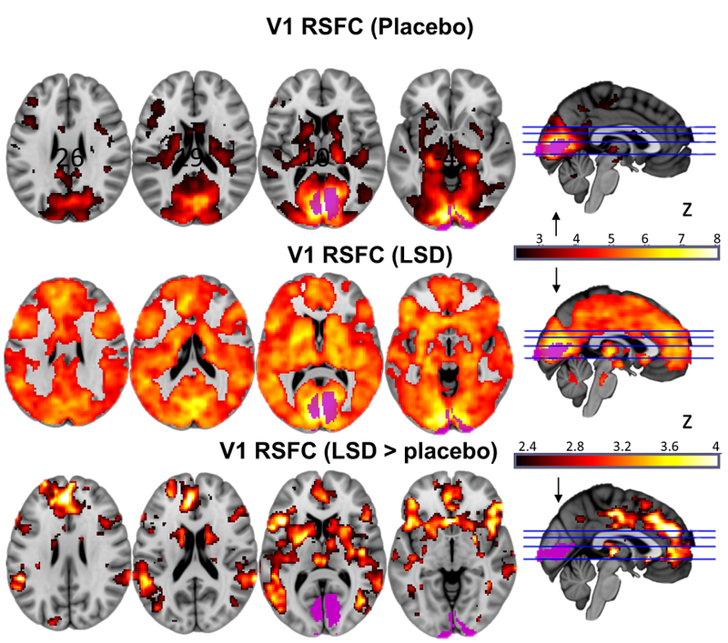 Primary visual cortex communication under placebo (top), LSD (2nd row) and difference (bottom row). Image: Imperial College London